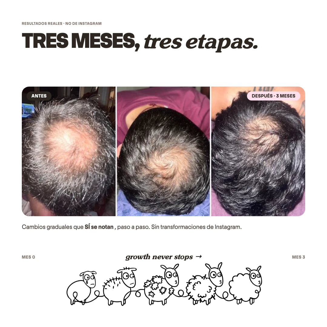 Tratamiento Caída Severa de Cabello x 3 Meses + Biotina