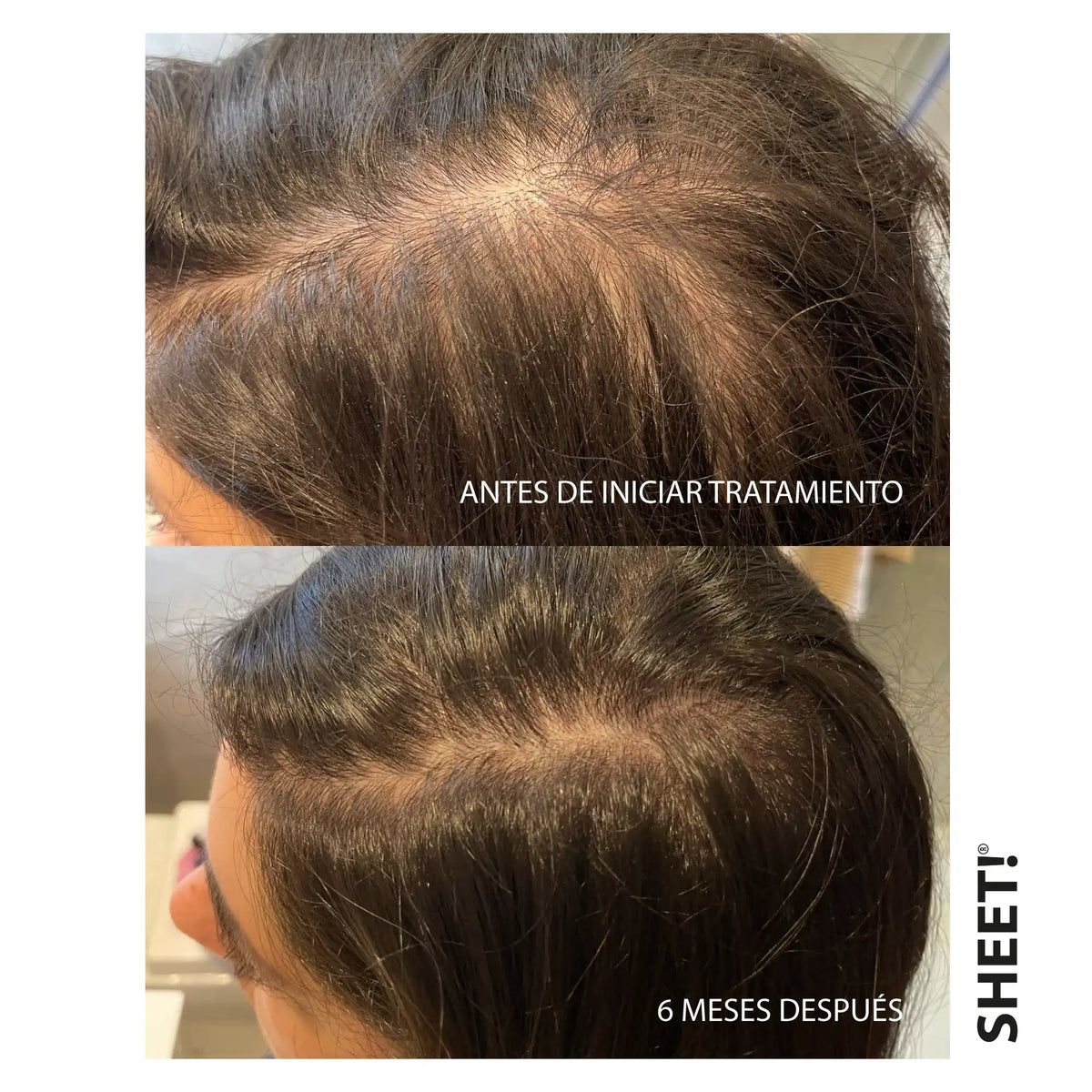 Tratamiento Anticaída x 1 Mes + Vitaminas para el Pelo